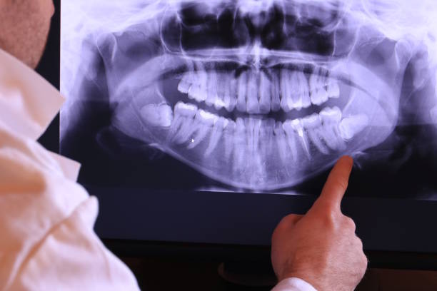 Best Dentist for Tooth Abscess  in St David, AZ